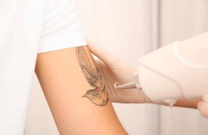 Tattoo Removal in Austin: The Ultimate Guide to Reversing Regrets