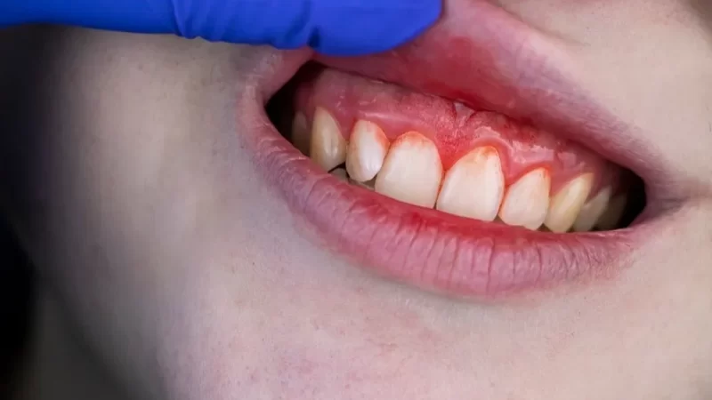 Impact of Genetics on Gum Diseases in Lincoln, NE