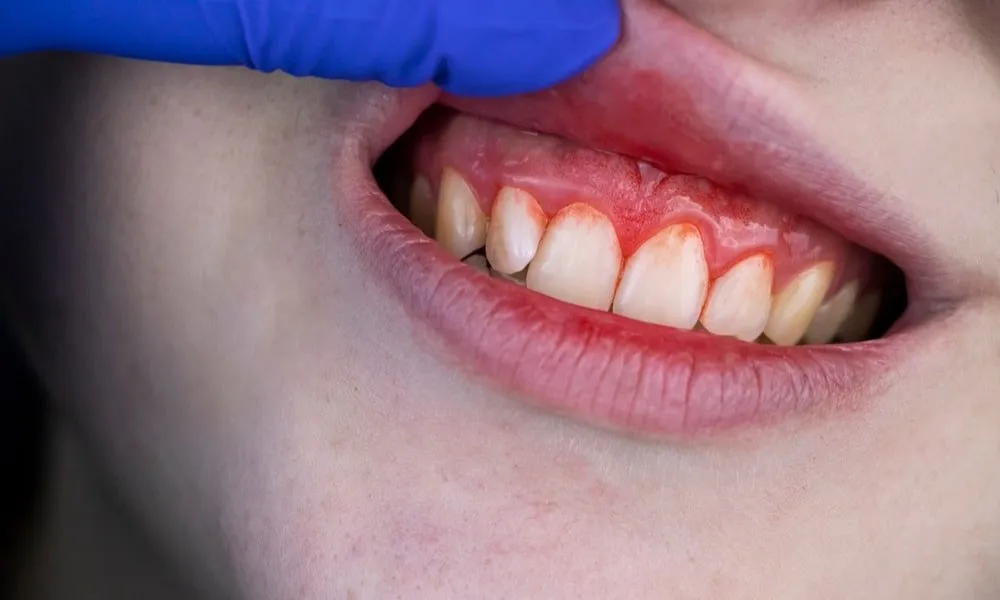 Impact of Genetics on Gum Diseases in Lincoln, NE