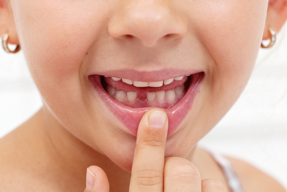 The Importance of Early Orthodontic Evaluation for Children