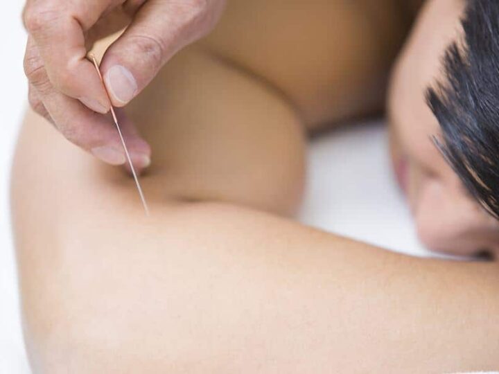 Insight Into The Use Of Acupuncture In Pain Management By Specialists