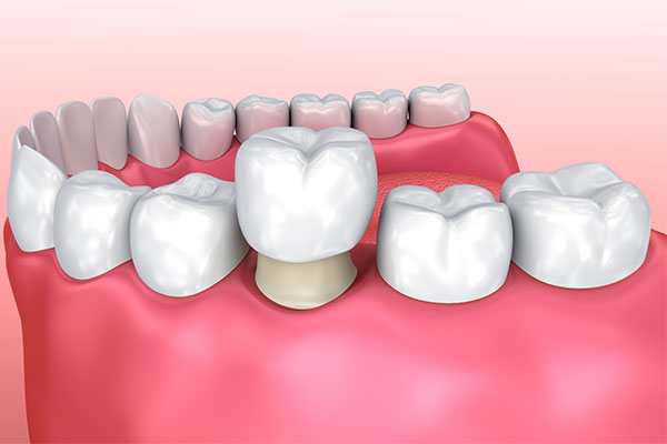 dental crowns