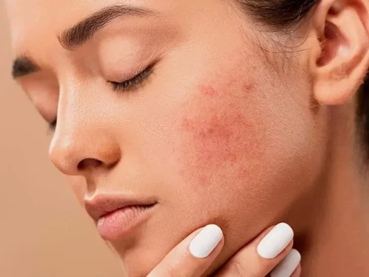 The Dermatologist’s Role In Managing Hormonal Acne