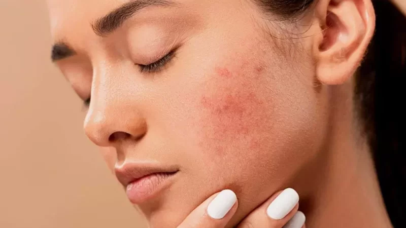 The Dermatologist’s Role In Managing Hormonal Acne