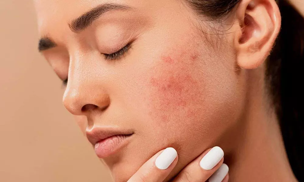 The Dermatologist’s Role In Managing Hormonal Acne