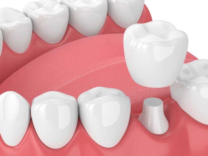 Dental Crowns: The Most Frequent Problems and Tips for Long-lasting Results