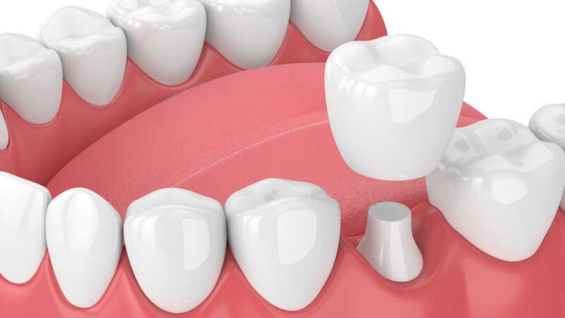 Dental Crowns: The Most Frequent Problems and Tips for Long-lasting Results