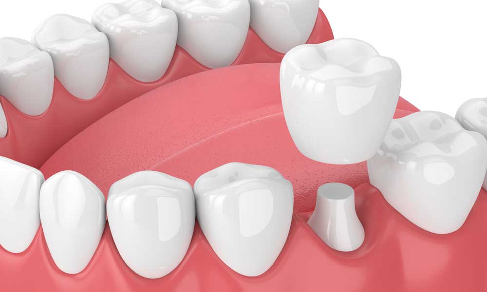 Dental Crowns: The Most Frequent Problems and Tips for Long-lasting Results