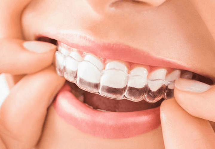 Invisalign During Pregnancy – Is It Safe? 