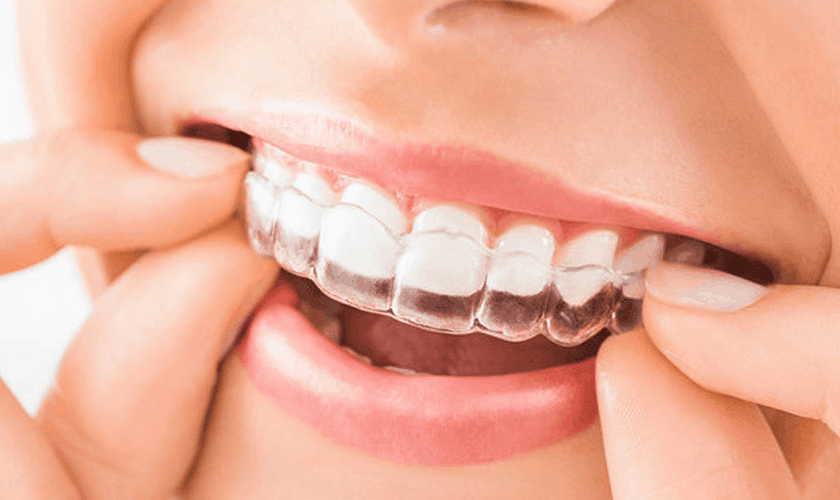 Invisalign During Pregnancy – Is It Safe? 