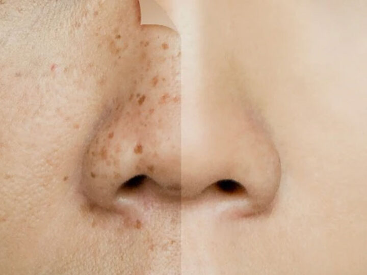 Pigmentation Laser Treatments for Clear, Even Skin and Radiant Complexion