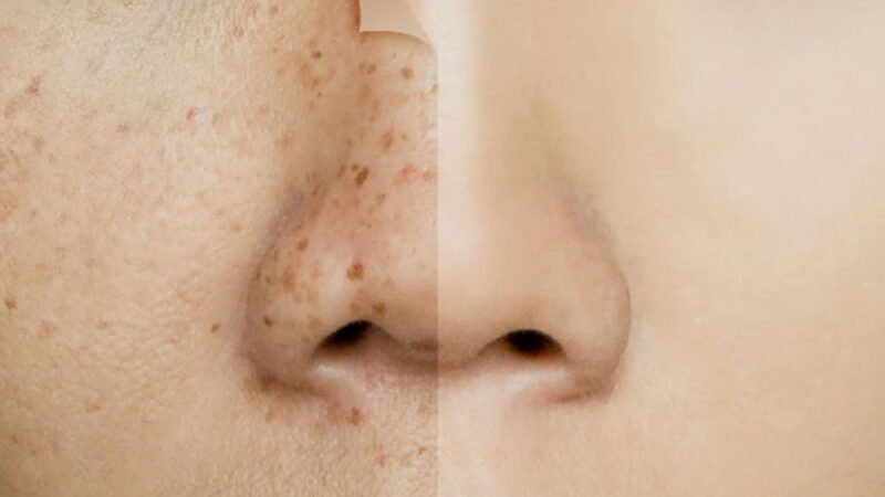 Pigmentation Laser Treatments for Clear, Even Skin and Radiant Complexion