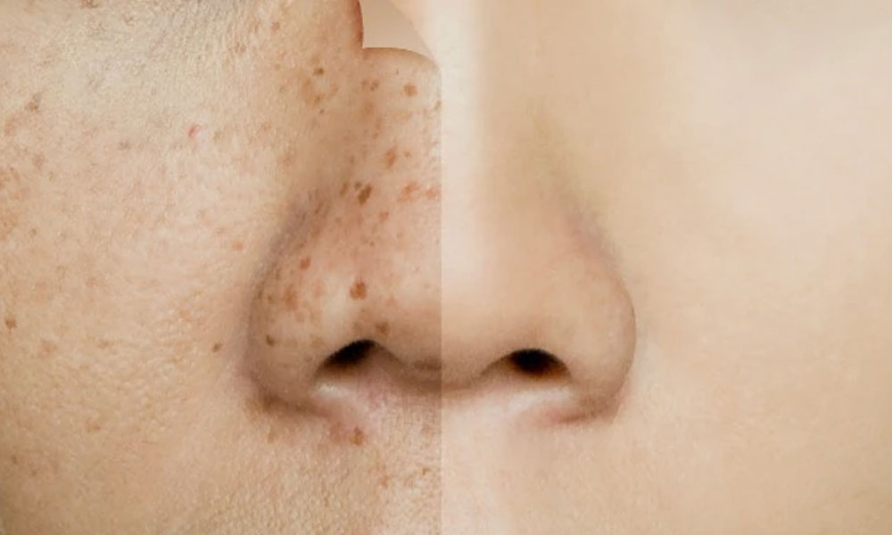 Pigmentation Laser Treatments for Clear, Even Skin and Radiant Complexion