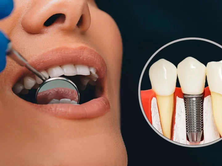 Understanding Implant Bridges: A Comprehensive Guide to Restoring Your Smile