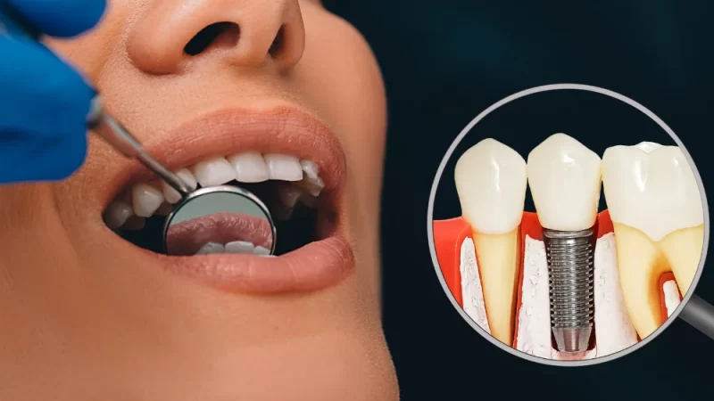 Understanding Implant Bridges: A Comprehensive Guide to Restoring Your Smile