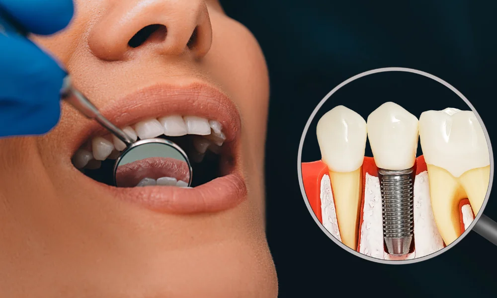 Understanding Implant Bridges: A Comprehensive Guide to Restoring Your Smile