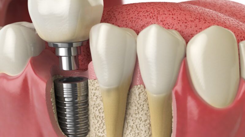 Dental Implant Restorations in Patients with Bruxism: A Clinical Review