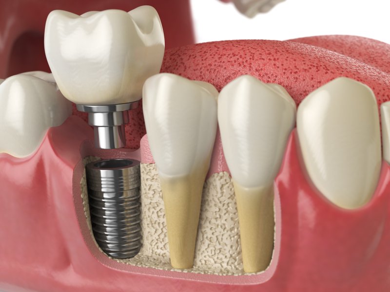 Dental Implant Restorations in Patients with Bruxism: A Clinical Review