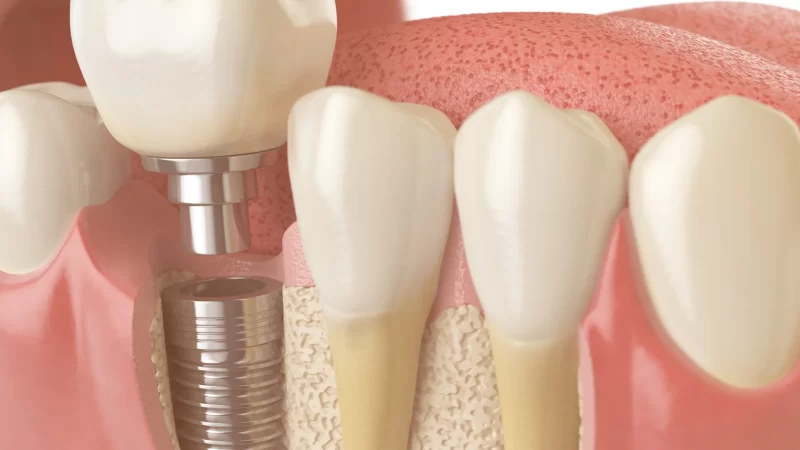 Top Questions to Ask Your Implant Dentist Before Getting Started