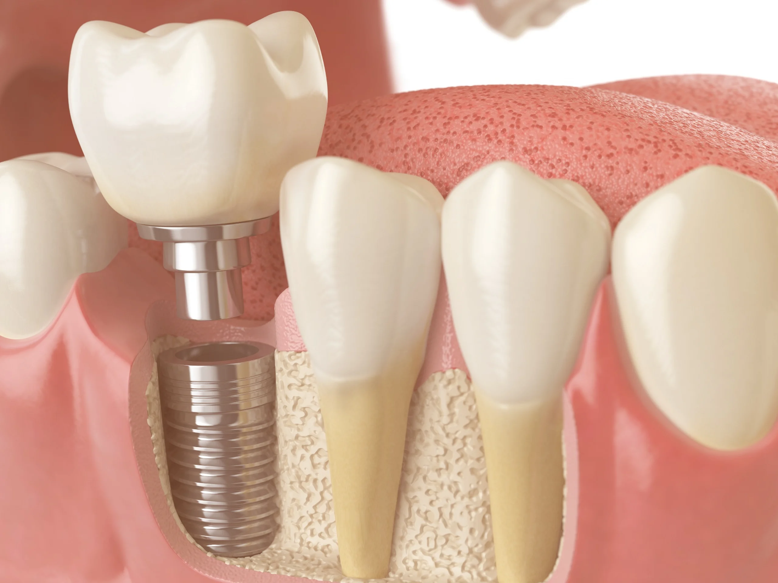 Top Questions to Ask Your Implant Dentist Before Getting Started