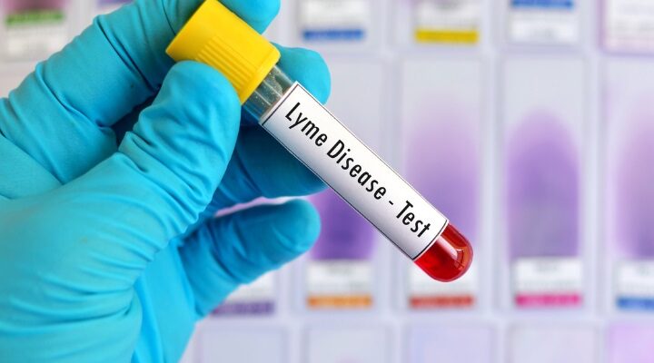 When You Need a Lyme Disease Test